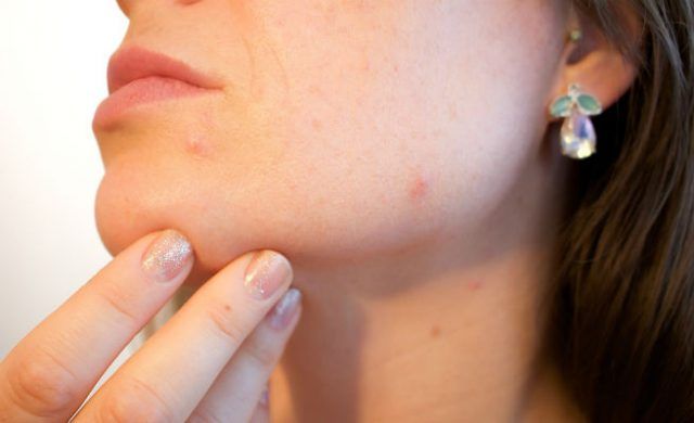acne-n