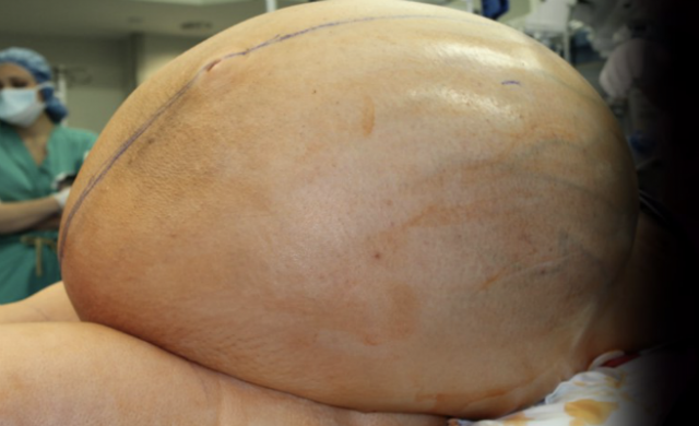 tumor-656