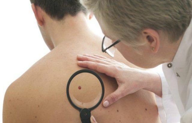 piel-cancer-lista