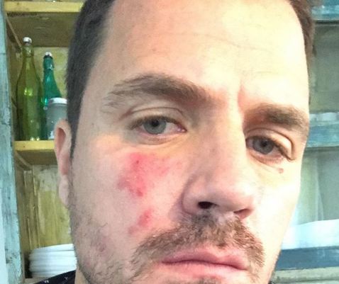 Dani Martin confiesa el problema de piel que padece