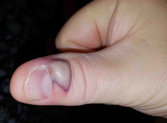Desarrolla una enfermedad mortal por morderse las uñas