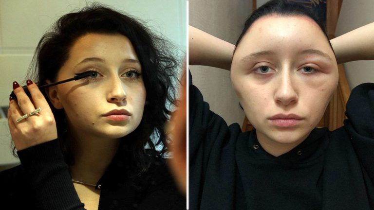 Una reacción alérgica a un tinte de cabello casi le cuesta la vida a una francesa: «Tenía la cabeza de bombilla»