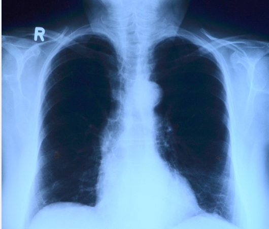 Una mujer muere de cáncer tras recibir un trasplante de pulmones de una fumadora