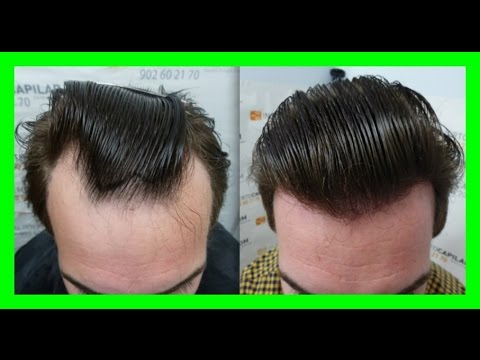 ¿Cuántos pelos se tienen que caer al día para preocuparse por la calvicie?
