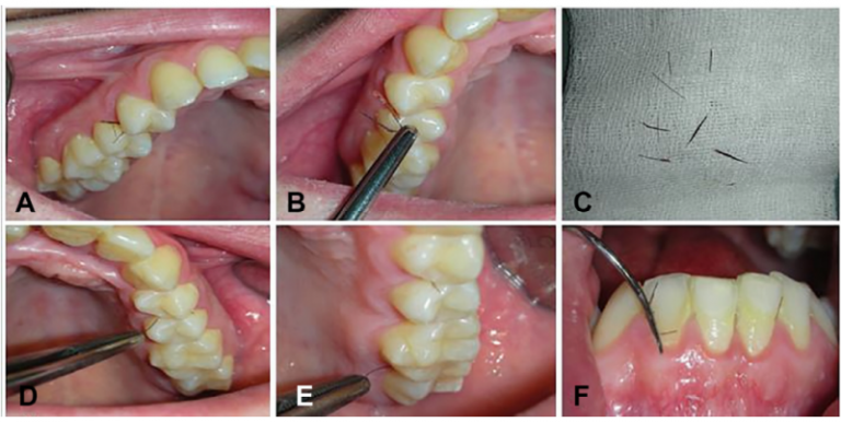 Una extraña enfermedad hace que a una mujer le crezca pelo entre los dientes