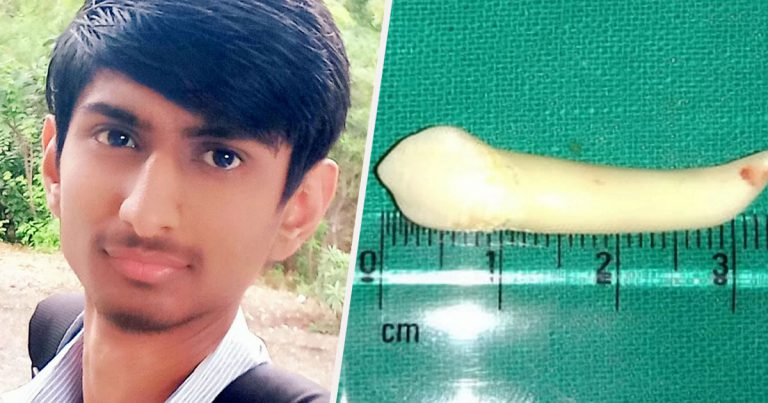 Un dentista extrae el diente más largo del mundo