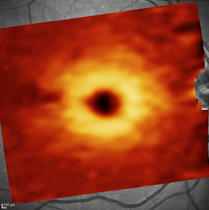 Fondo De Ojo Donde Se Representa El Mapa Del Espesor De Las Células Ganglionares A Nivel Macular