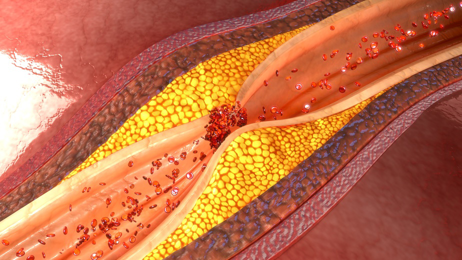 Qué Es La Dislipidemia