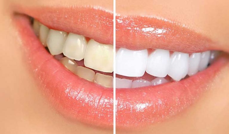 Alimentos que dañan el blanco de tus dientes y aún así los tomas