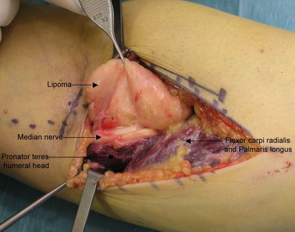 Qué Es Un Lipoma