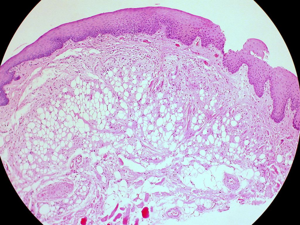 Qué Es Un Lipoma