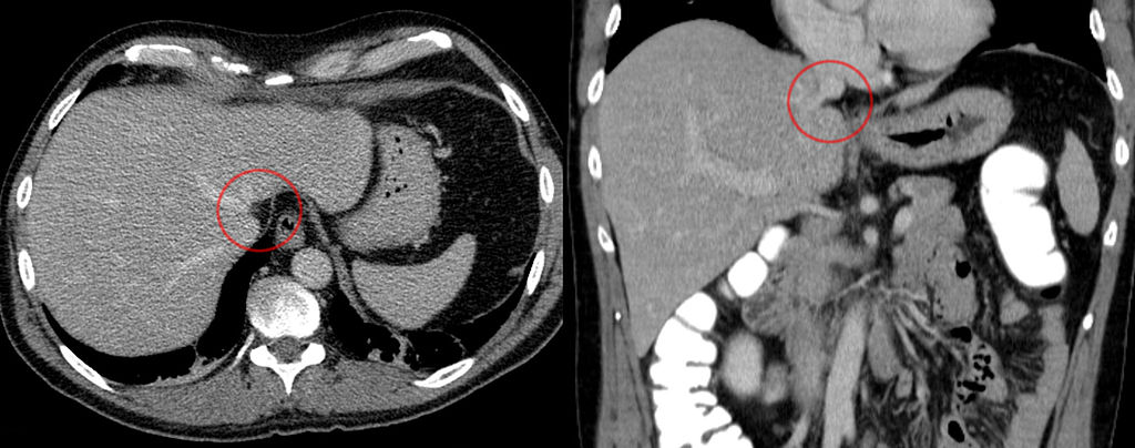 Qué Es Un Lipoma