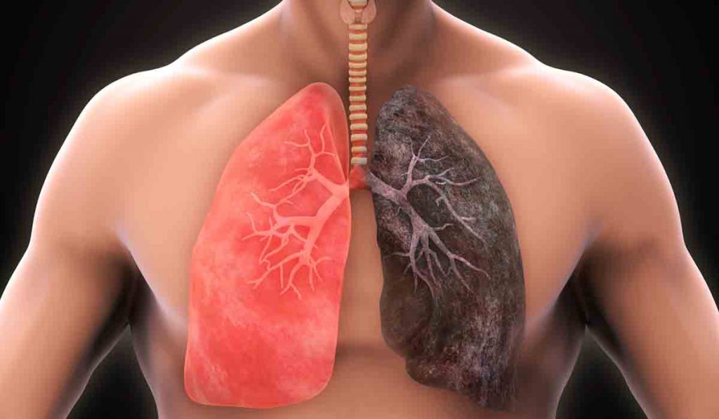 Problemas Con Los Pulmones