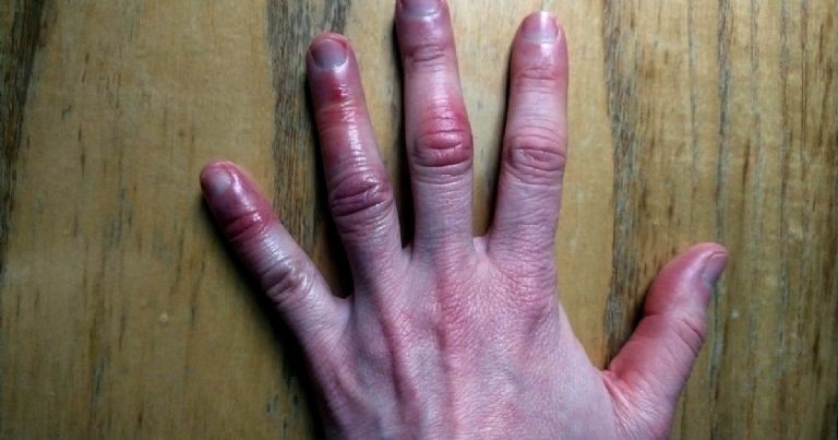 Síndrome de los "dedos congelados" por la covid-19