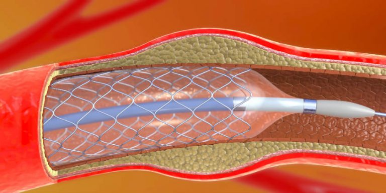 Qué es un stent