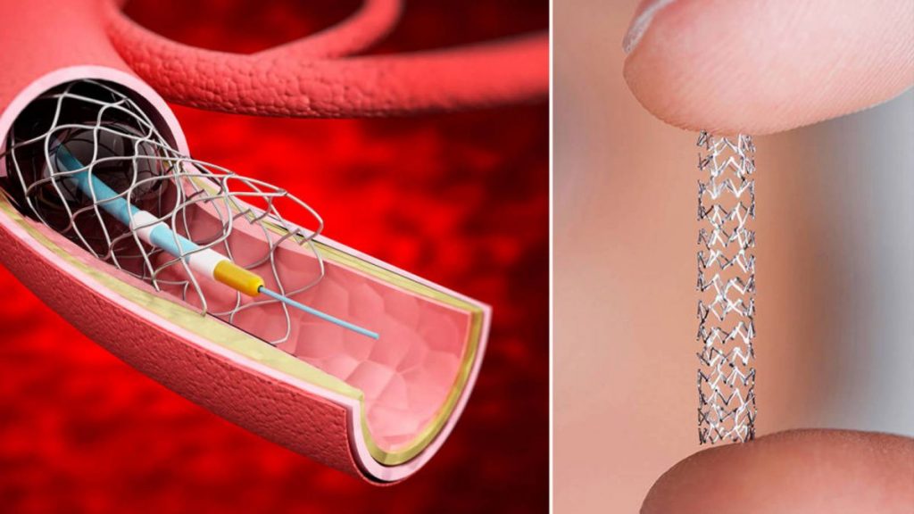 Cómo Funciona Un Stent