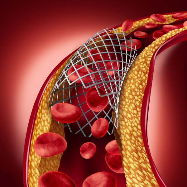 Concretamente Que Controles Son Necesarios Como Pacientes Con Stent Coronario