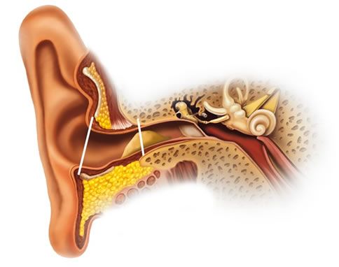¿Qué Ocasiona La Formación De Tapones En Los Oídos?