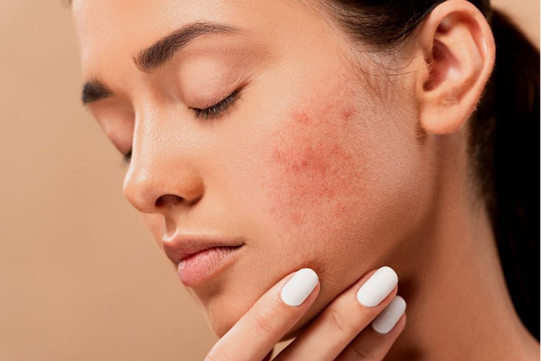 Según dónde tengas acné este es el problema de salud que tienes