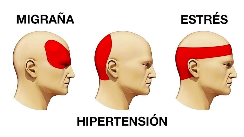 Lugares En Los Que Se Presenta Frecuentemente Un Dolor De Cabeza