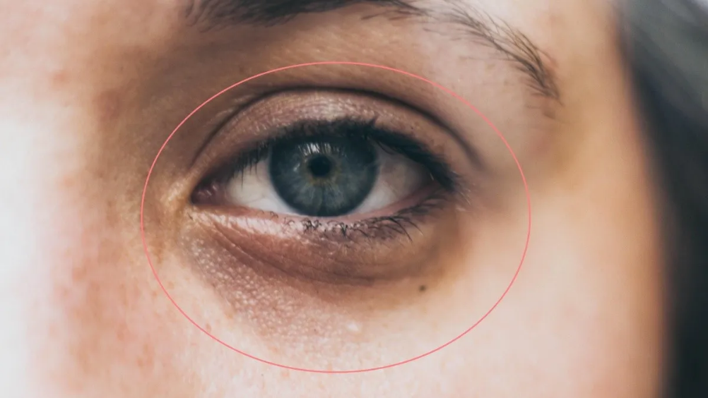 Cómo Eliminar Las Ojeras De Tu Rostro De Manera Fulminante 