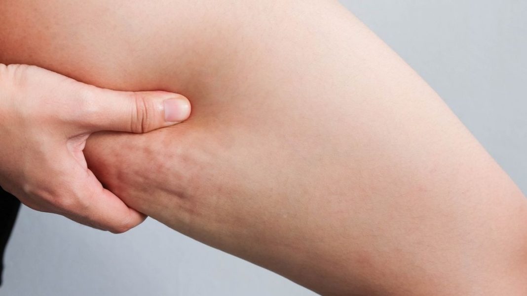 Celulitis: cómo tratarla y eliminarla de tu piel