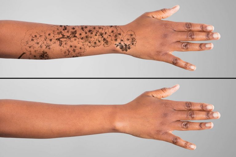 Cómo borrar un tatuaje: métodos que funcionan y son seguros