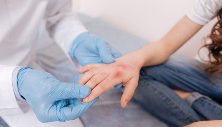 Qué es vasculitis