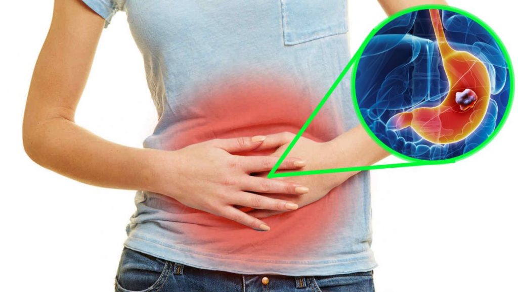 Cáncer de estómago: estos son los síntomas que lo delatan