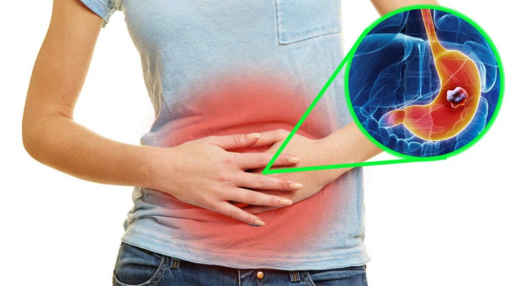 Cáncer De Estómago: Estos Son Los Síntomas Que Lo Delatan