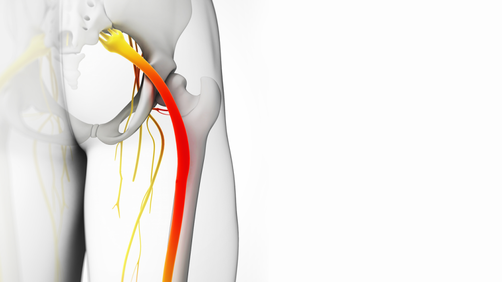 Ciática: Así Te Avisa Tu Cuerpo De Que Algo Va Mal 9 Ten En Cuenta Los Factores De Riesgo De La Ciática
