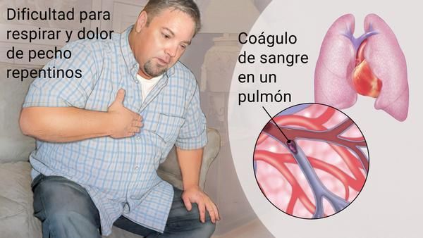 Síntomas De Una Embolia Pulmonar 