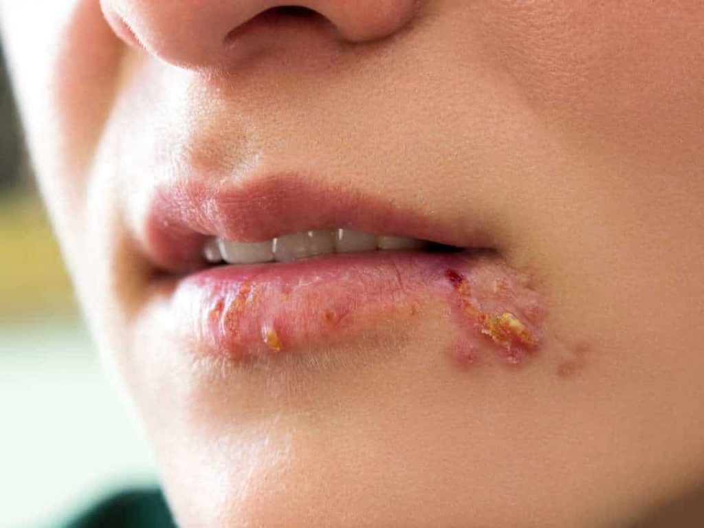Herpes