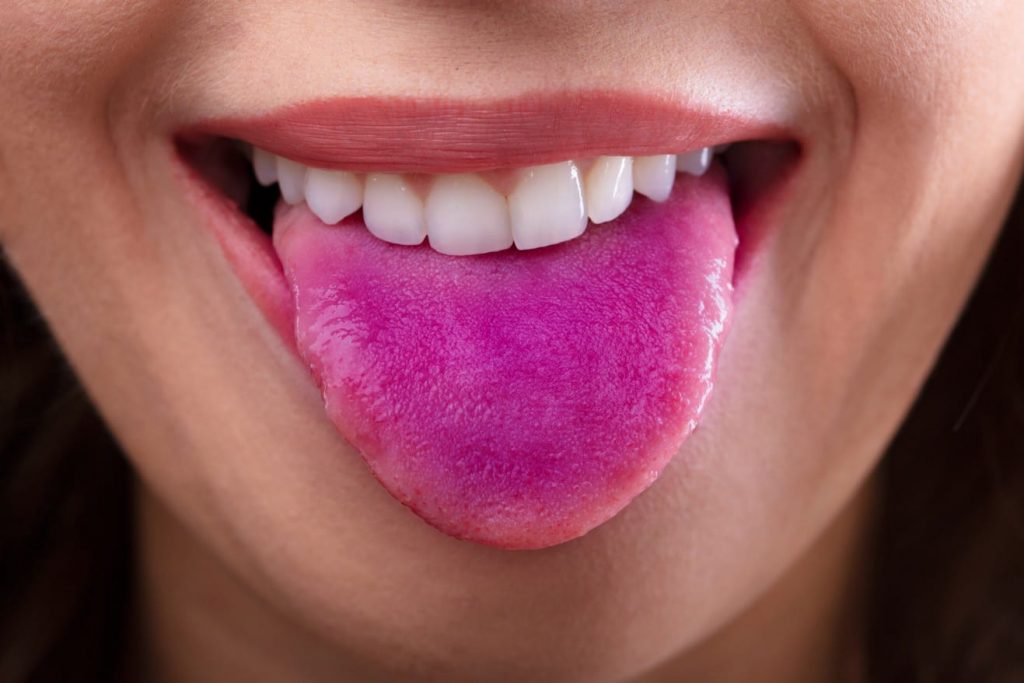 Purpura