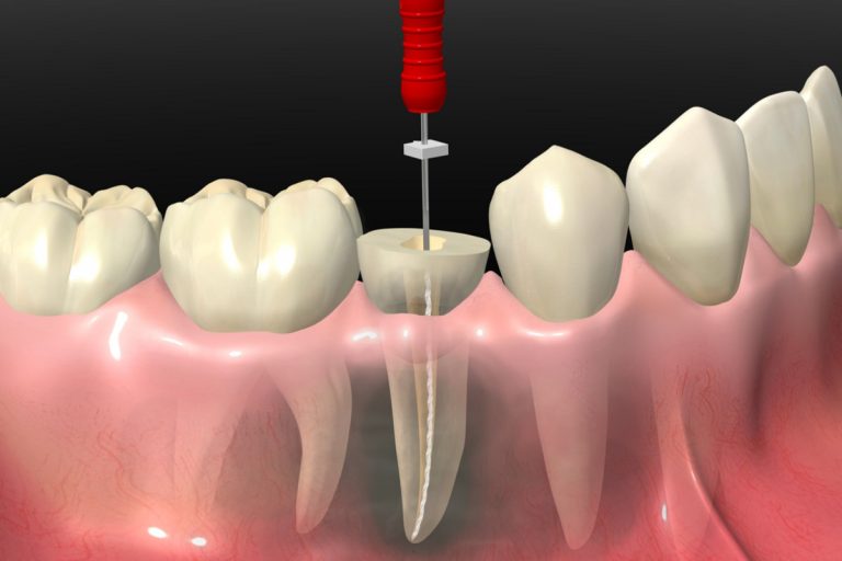 Qué es una endodoncia