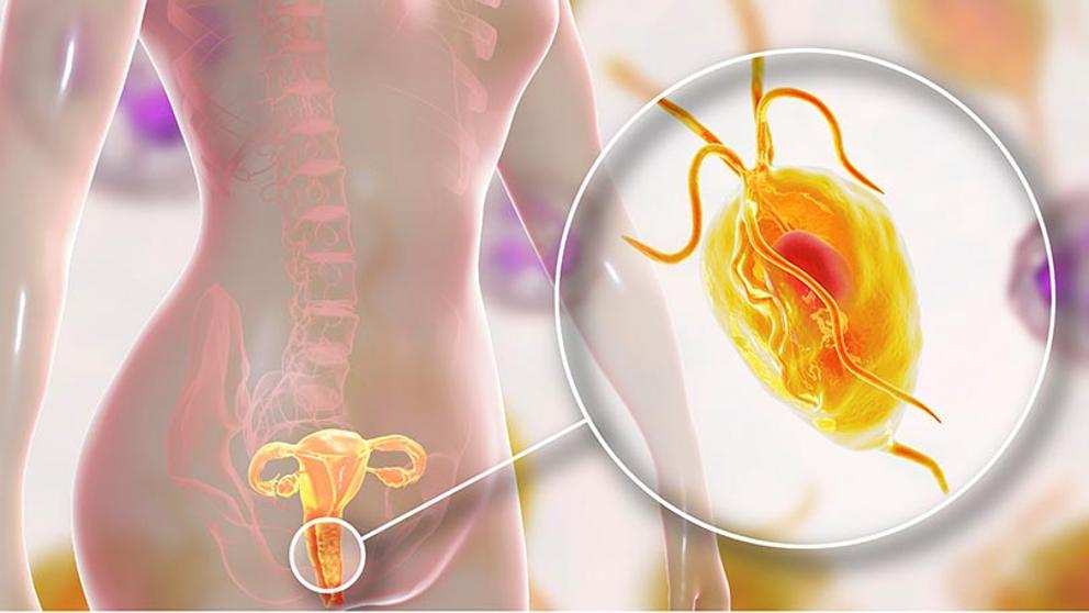 ¿Cómo Se Contagia La Tricomoniasis?