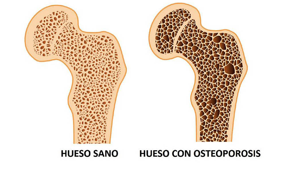 Aspecto de un hueso con osteoporosis