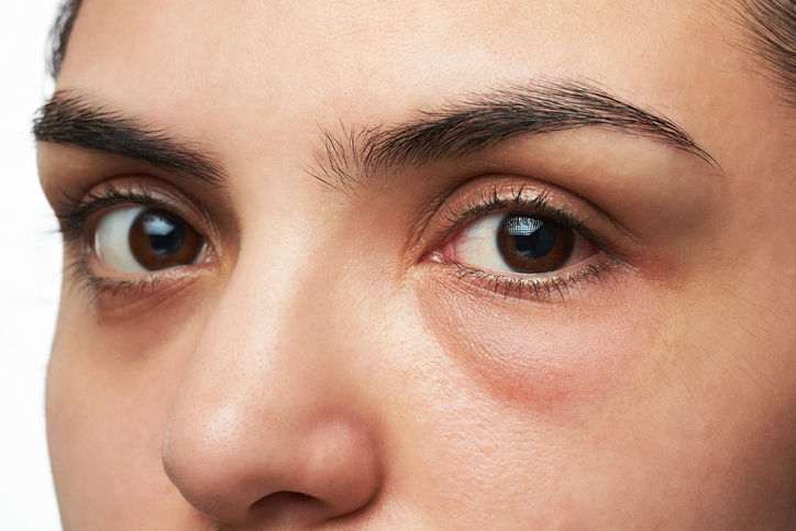 Eliminar Las Bosas De Los Ojos Con  Photoshop