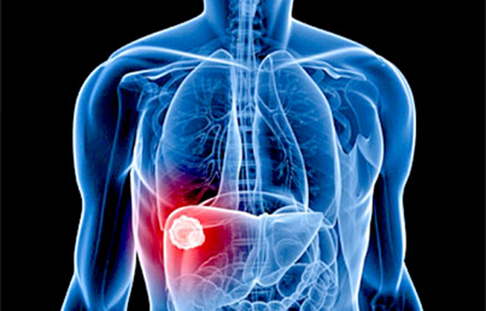 El caso de la Hepatitis