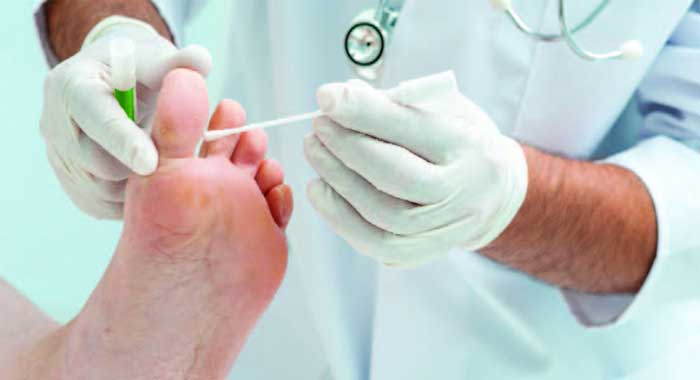 Posibles infecciones por hongos