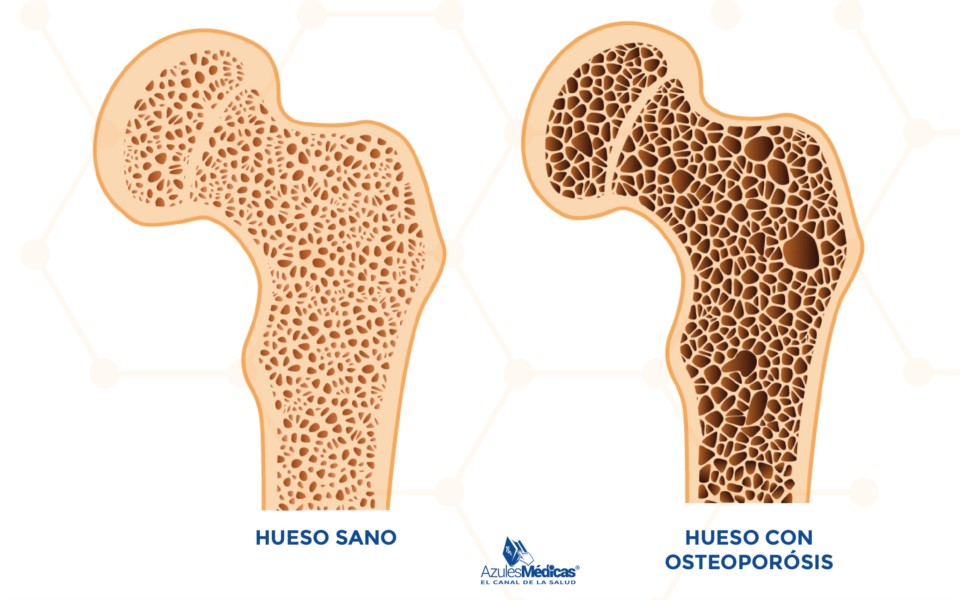 ¿Qué Genera La Osteoporosis?