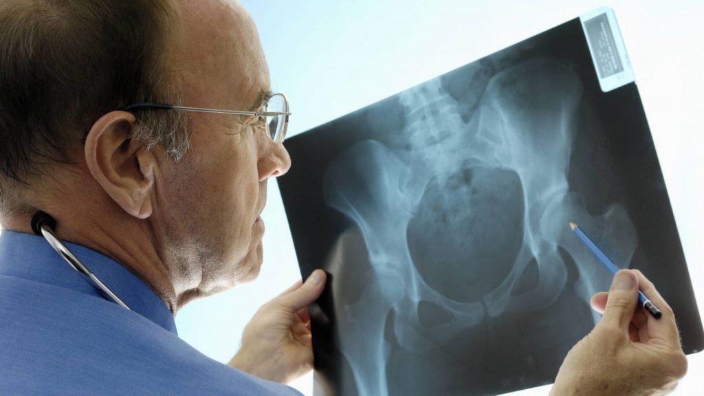 Osteoporosis y los factores de riesgo 