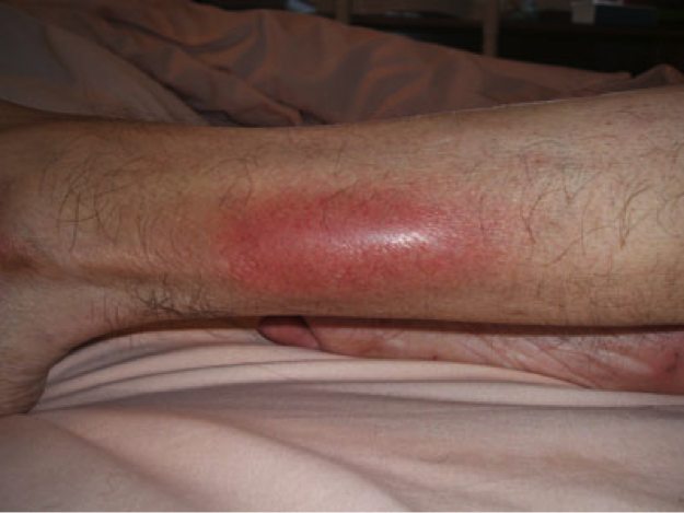 Flebitis Bacteriana