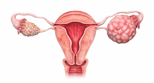 Qué Es La Ginecología 9 Cáncer De Mama, Ovario Y Útero