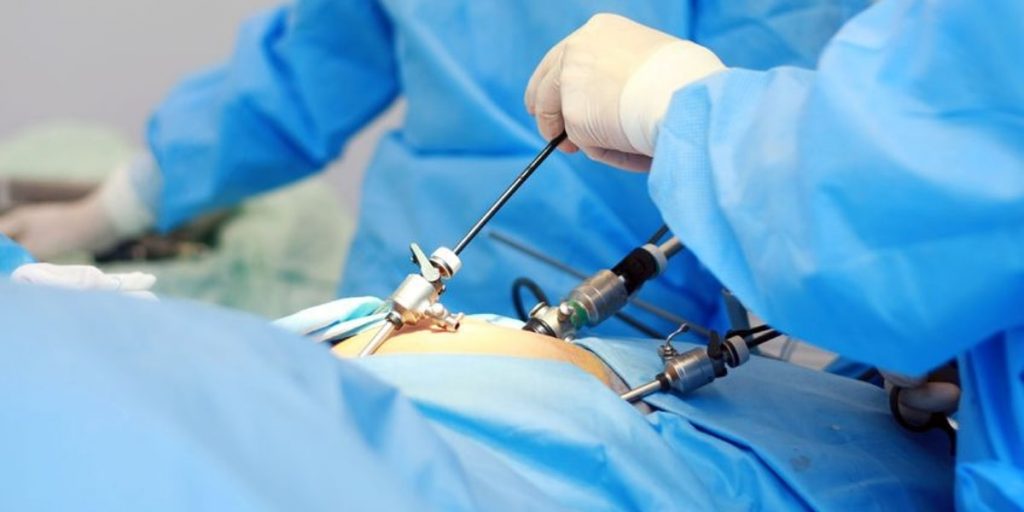 Qué Es La Ginecología 11 Laparoscopia Ginecológica