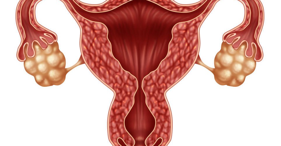 Síndrome Del Ovario Poliquístico (Sop)