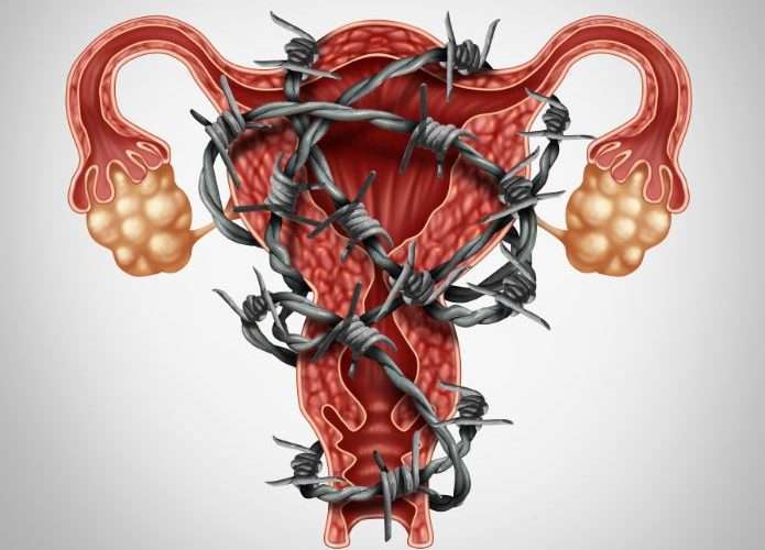 Qué Es La Ginecología 7 Endometriosis