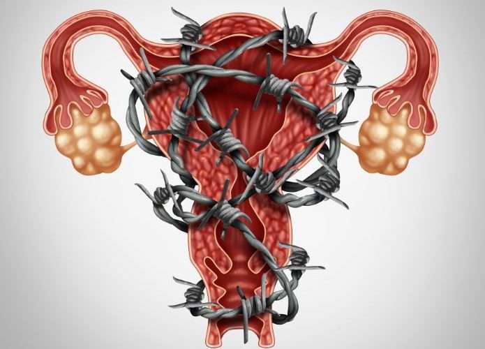 Endometriosis