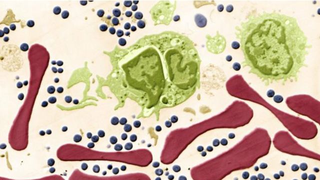 Qué Es Septicemia 1 ¿Qué Causa La Septicemia?