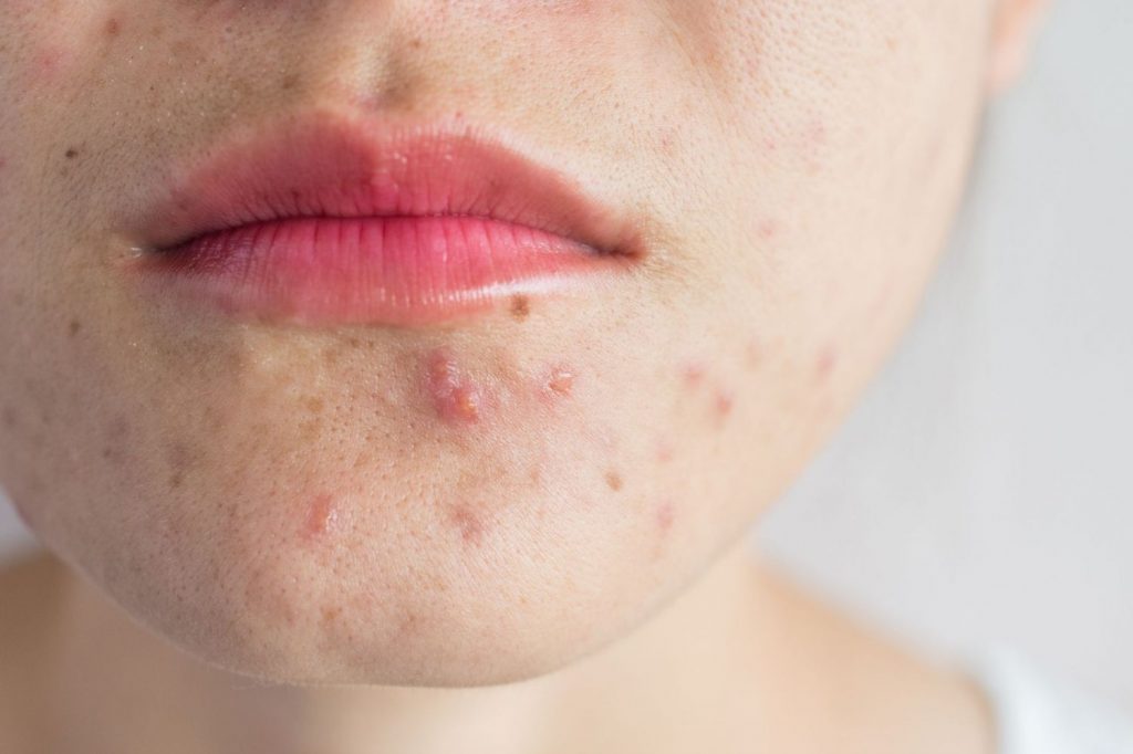 Mascarilla: Cómo Cuidar Las Orejas Después Del Maltrato Que Sufren A Diario